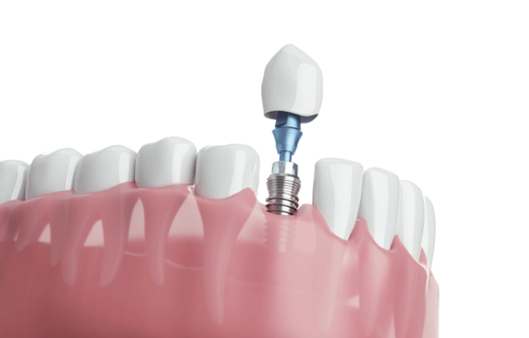 インプラント治療