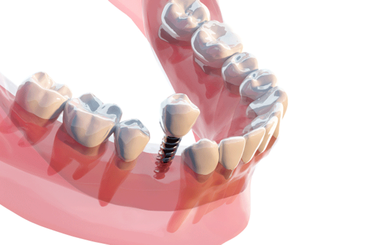 安全・安心を重視したインプラント治療