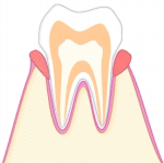 軽度の歯周病