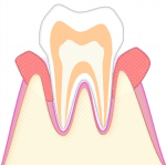 中度の歯周病