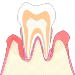 重度の歯周病